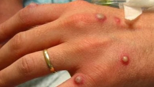 В Грузии выявили первый случай заражения оспой обезьян