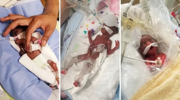 «Шанс на выживание — 0%». Эти близнецы считаются самыми недоношенными в мире