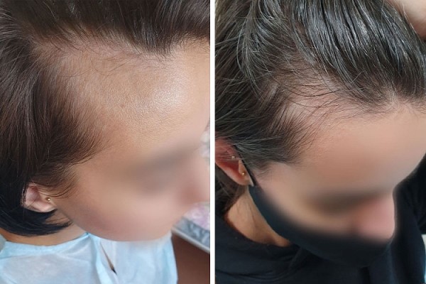 Как белорусы пересаживают волосы