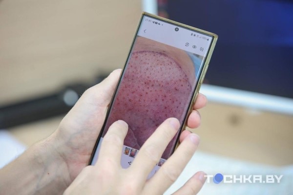 Как белорусы пересаживают волосы