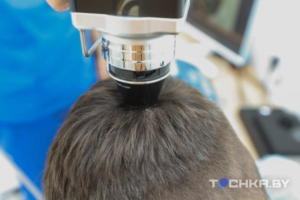 Как белорусы пересаживают волосы