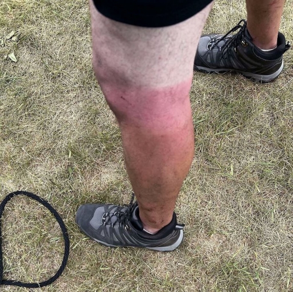 Эти фотографии показали, почему использовать солнцезащитный крем — хорошая идея! Эти фотографии показали, почему использовать солнцезащитный крем — хорошая идея!